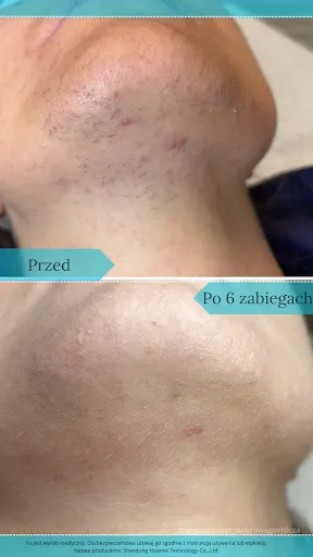 Depilacja Dąbrowa Górnicza - DepilConcept